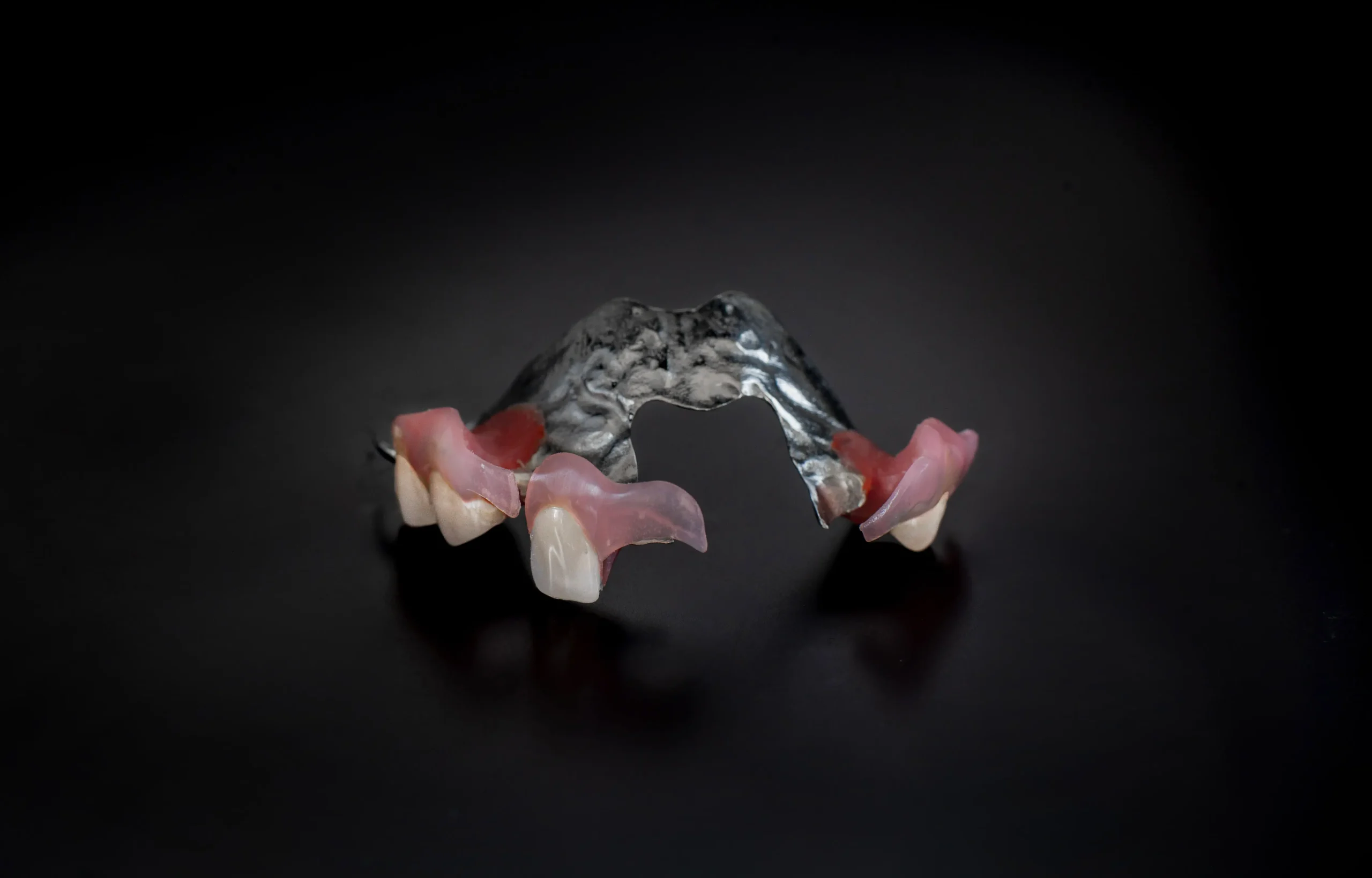 Proteza Hybrydowa (szkieletowo – acronowa)