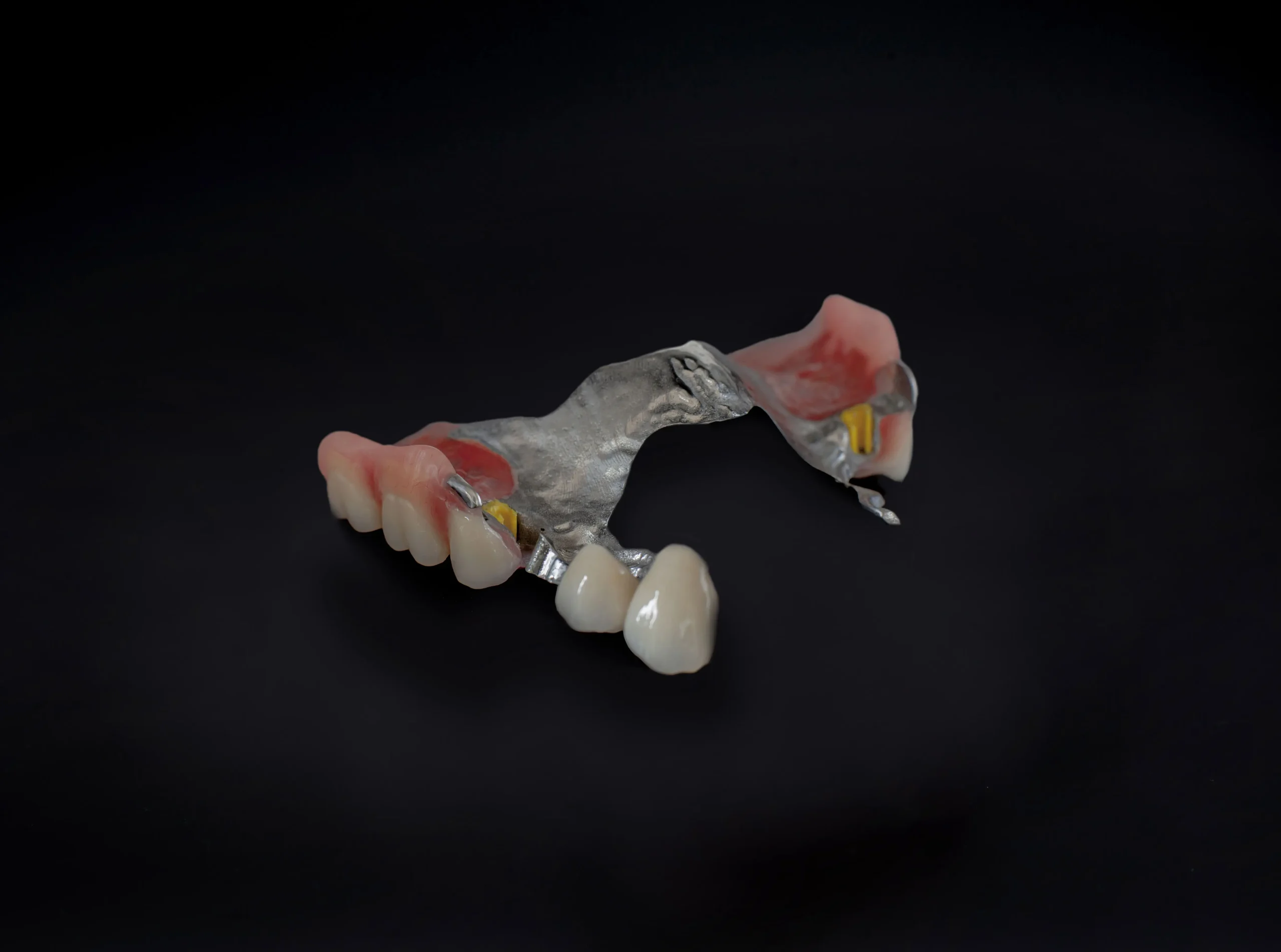 Proteza szkieletowa na zasuwach